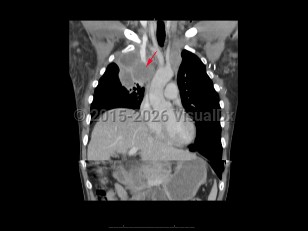 Imaging Studies image of Superior vena cava syndrome - imageId=7873123. Click to open in gallery.  caption: 'A 64 year old patient with known lung cancer presented with increasing facial swelling and shortness of  breath. Coronal CT image demonstrates encasement and obstruction of the SVC by a large right upper lobe mass. Findings consistent with SVC syndrome.'