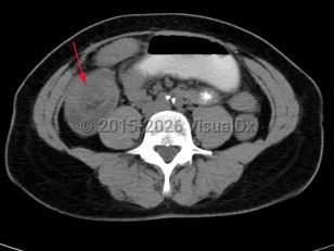Imaging Studies image of Intussusception - imageId=7873692. Click to open in gallery.  caption: '<span>CT scan demonstrating colo-colo intussusception in the right lower quadrant.</span>'