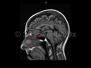 Imaging Studies image of Craniopharyngioma - imageId=7877583. Click to open in gallery.  caption: '<span>Sagittal T1  weighted MRI demonstrates the mass in the sellar/suprasellar  region. The hypointense portions of the mass are secondary to the  calcifications identified on CT.</span>'