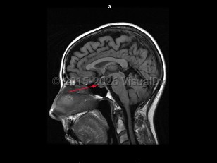 Imaging Studies image of Craniopharyngioma - imageId=7877583. Click to open in gallery.  caption: '<span>Sagittal T1  weighted MRI demonstrates the mass in the sellar/suprasellar  region. The hypointense portions of the mass are secondary to the  calcifications identified on CT.</span>'