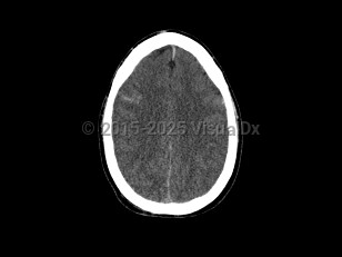 Imaging Studies image of Cerebral edema - imageId=7877814. Click to open in gallery.  caption: '<span>Axial CT image demonstrates  diffuse loss of the gray-white matter interface and sulcal prominence.  Findings were consistent with post-traumatic diffuse cerebral edema.</span>'