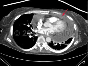 Imaging Studies image of Cardiac tamponade - imageId=7878229. Click to open in gallery.  caption: '<span>Axial CT image demonstrates a  large pericardial effusion which is flattening the cardiac ventricles  and concerning for tamponade.</span>'