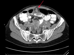 Imaging Studies image of Meckel diverticulum - imageId=7879679. Click to open in gallery.  caption: '<span>CT scan of abdomen and pelvis demonstrating enhancing nodular focus extending from ileum, which was pathology-proven Meckel diverticulitis.</span>'