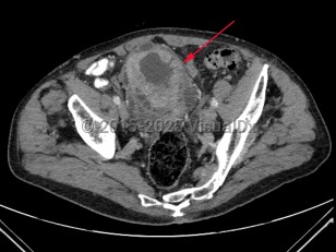 Imaging Studies image of Bladder cancer - imageId=7885454. Click to open in gallery.  caption: '<span>Axial image from an enhanced CT scan of the pelvis  demonstrating marked irregular wall thickening of the bladder.</span>'