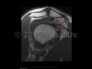 Imaging Studies image of Adhesive capsulitis of the shoulder - imageId=7887104. Click to open in gallery.  caption: '<span>Sag proton density MRI  sequence demonstrates scarring in the region of the rotator interval fat  which is a secondary sign of adhesive capsulitis.</span>'