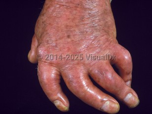Psoriatic arthritis