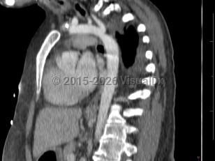 Imaging Studies image of Coarctation of the aorta - imageId=7903687. Click to open in gallery.  caption: '<span>CT image demonstrates focal  narrowing of the aorta just distal to the origin of the left subclavian  artery in this patient with known aortic coarctation.</span>'