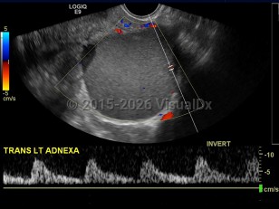 Endometriosis