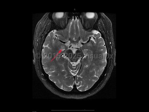 Imaging Studies image of Encephalitis - imageId=7904332. Click to open in gallery.  caption: '<span>Limbic encephalitis. Axial T2  weighted MRI of the brain demonstrates increased signal in the  right mesial temporal lobe, in this patient with small cell lung  carcinoma. Findings were consistent with a clinical diagnosis of limbic  encephalitis.</span>'