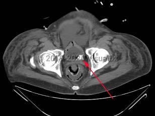 Imaging Studies image of Urinary bladder calculus - imageId=7906147. Click to open in gallery.  caption: '<span>CT scan of the pelvis, showing bladder calculi.</span>'