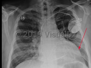 Imaging Studies image of Dilated cardiomyopathy - imageId=7906304. Click to open in gallery.  caption: '<span>PA chest x-ray demonstrating an enlarged heart in a patient with known cardiomyopathy.</span>'