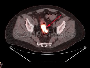 Imaging Studies image of Rectal carcinoma - imageId=7911680. Click to open in gallery.  caption: 'Fused image from PET/CT scan of the pelvis demonstrating hypermetabolic wall thickening of the rectosigmoid, corresponding to pathology-proven cancer.'