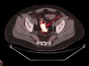 Imaging Studies image of Rectal carcinoma - imageId=7911680. Click to open in gallery.  caption: 'Fused image from PET/CT scan of the pelvis demonstrating hypermetabolic wall thickening of the rectosigmoid, corresponding to pathology-proven cancer.'