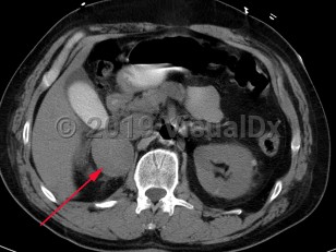 Imaging Studies image of Pheochromocytoma - imageId=7911948. Click to open in gallery.  caption: 'Patient presented with labile blood pressure. Unenhanced CT scan of the abdomen demonstrates a large complex right adrenal mass, surgically proven pheochromocytoma.'