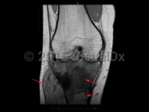 Imaging Studies image of Osteosarcoma - imageId=7912443. Click to open in gallery.  caption: '<span>Coronal T1 MRI sequence  demonstrates an infiltrative mass within the proximal tibial metaphysis  with low T1 signal, periosteal reaction/breakthrough, and an associated  soft tissue mass. These findings are compatible with an osteosarcoma.</span>'