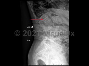 Imaging Studies image of Osteoporotic vertebral compression fracture - imageId=7914694. Click to open in gallery.  caption: '<span>Compression fracture of the L1  vertebral body involving both the superior and inferior endplates in a  patient with diffuse osteopenia, compatible with an osteoporotic  compression fracture.</span>'