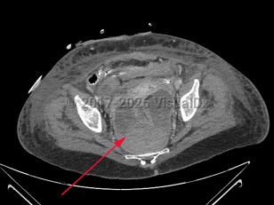 Imaging Studies image of Perirectal abscess - imageId=7915658. Click to open in gallery.  caption: '<span>Axial CT image of a  large perirectal abscess with hemorrhage in a patient recently  postoperative with rectal perforation.</span>'