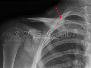 Imaging Studies image of Chronic recurrent multifocal osteomyelitis - imageId=7918092. Click to open in gallery.  caption: '<span>Hyperostosis and chronic  lamellated periosteal reaction involving the medial end of the clavicle.  These findings can be seen with CRMO.</span>'