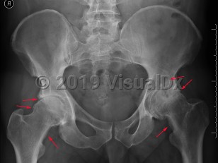 Imaging Studies image of Osteoarthritis - imageId=7919527. Click to open in gallery.  caption: '<span>Severe degenerative disease of  the left hip with joint space narrowing, subchondral sclerosis,  subchondral cysts, and osteophytosis. Moderate degenerative disease of  the right hip. There is also buttressing bilaterally. Findings are  compatible with osteoarthritis.</span>'