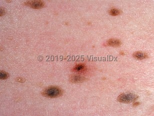 Clinical image of Familial atypical multiple mole-melanoma syndrome - imageId=806364. Click to open in gallery.  caption: 'A close-up of numerous homogenous and variegated brown macules, papules, and plaques. Note also the reddish papule with a central blackish color (the "ugly duckling"- suspicious for melanoma).'
