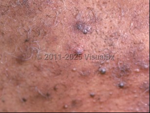 Clinical image of Steroid acne - imageId=816855. Click to open in gallery.  caption: 'A close-up of follicular-based, closed comedones and papules, resulting from topical steroid use.'