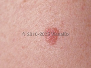 Clinical image of Lichenoid keratosis - imageId=82272. Click to open in gallery.  caption: 'A close-up of a pink-brown, edematous, stuck-on, verrucous plaque.'