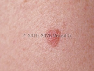 Clinical image of Lichenoid keratosis - imageId=82272. Click to open in gallery.  caption: 'A close-up of a pink-brown, edematous, stuck-on, verrucous plaque.'