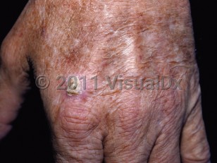 Clinical image of Actinic keratosis - imageId=82332. Click to open in gallery.  caption: 'An adherent mound of scale atop a thin pink plaque.'