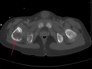 Eosinophilic granuloma of bone