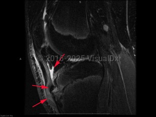 Imaging Studies image of Osgood-Schlatter disease - imageId=8337407. Click to open in gallery.  caption: '<span>Sag intermediate weighted fat  saturated MRI sequence demonstrates bone marrow edema in the region of  the fragmented tibial tubercle, with adjacent patellar tendonosis, and  deep infrapatellar bursitis. These findings are compatible with Osgood  Schlatter disease.</span>'