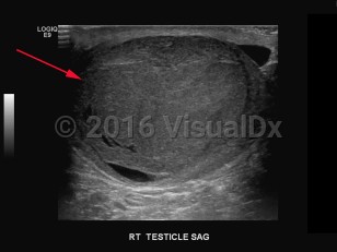 Imaging Studies image of Testicular cancer - imageId=8342371. Click to open in gallery.  caption: '<span>Grayscale ultrasound image of the right testicle demonstrating a large heterogeneous mass occupying the entire testicle. Pathology-proven classic seminoma.</span>'
