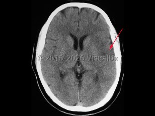 Imaging Studies image of Cerebral stroke - imageId=8342528. Click to open in gallery.  caption: '<span>CAT scan demonstrating left-sided MCA territory stroke, seen as hypodense region in left temporal lobe.</span>'