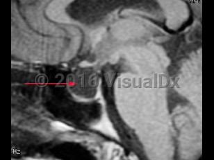 Imaging Studies image of Empty sella syndrome - imageId=8342670. Click to open in gallery.  caption: '<span>MRI demonstrating empty sella turcica.</span>'