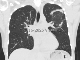Cryptogenic organizing pneumonia