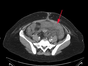 Acute mesenteric ischemia