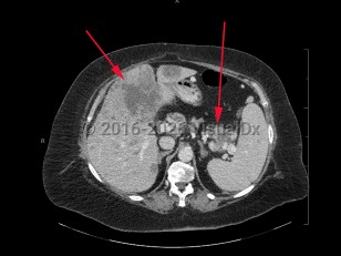 Metastatic pancreatic carcinoma