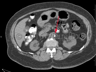 Imaging Studies image of Renal artery stenosis - imageId=8361094. Click to open in gallery.  caption: '<span>Axial image from unenhanced CT scan of the abdomen demonstrating dense calcifications at the take off of the left renal artery, consistent with severe stenosis.</span>'