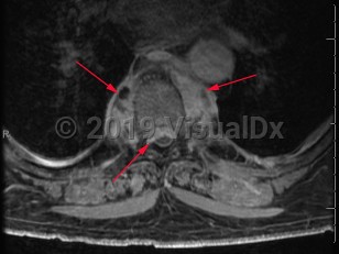 Imaging Studies image of Paraspinal abscess - imageId=8364015. Click to open in gallery.  caption: '<span>Axial T1FS post-contrast MRI  sequence demonstrates discitis osteomyelitis of the thoracic spine at  T7-T8 with an associated paravertebral abscess. Note the extent of  surrounding inflammatory changes in the paravertebral soft tissues - the  non-enhancing portion corresponded to a fluid collection.</span>'