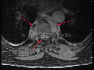 Paraspinal abscess