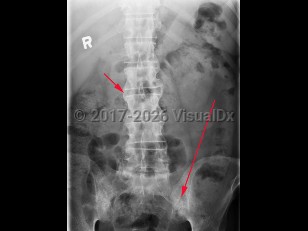 Imaging Studies image of Ankylosing spondylitis - imageId=8367603. Click to open in gallery.  caption: 'X-ray of abdomen showing erosion and reactive sclerosis invoving bilateral sacroiliac joints (long arrow), as well as bony spurs (syndesmophytes), along lateral aspects of lumbar vertebral bodies (short arrow). These are hallmark findings of ankylosing spondylitis.'