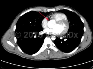 Imaging Studies image of Bicuspid aortic valve - imageId=8368284. Click to open in gallery.  caption: '<span>CT angiogram of chest demonstrates bicuspid aortic valve.</span>'