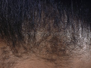 Clinical image of Traction alopecia - imageId=848460. Click to open in gallery.  caption: 'Patchy nonscarring alopecia at the anterior hairline.'