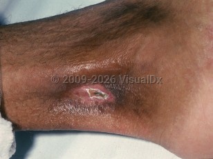 Sickle cell disease