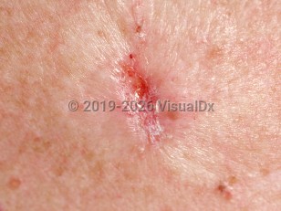 Clinical image of Infiltrating basal cell carcinoma - imageId=88519. Click to open in gallery.  caption: 'A close-up of a shiny, whitish-pink plaque with a central depressed erosion and scale.'