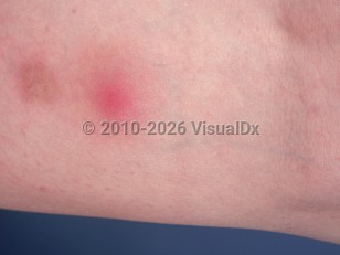 Clinical image of Nodular vasculitis - imageId=888633. Click to open in gallery.  caption: 'A close-up of a pink nodule with surrounding pink erythema on the leg.'