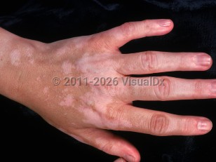 Clinical image of Vogt-Koyanagi-Harada syndrome - imageId=901376. Click to open in gallery.  caption: 'White and pale pink macules and patches (vitiligo) on the dorsal hand and fingers.'