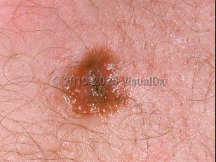 Clinical image of Spitz nevus - imageId=919616. Click to open in gallery.  caption: 'A close-up of a crusted, pink and light brown papule.'