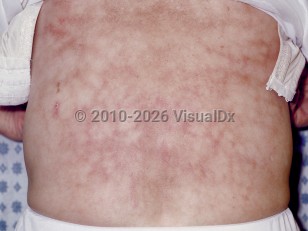 Clinical image of Erythema ab igne - imageId=93362. Click to open in gallery.  caption: 'Widespread mottled and reticulate erythema with associated light brown patches and a single crust on the back.'