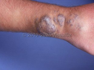 Cavernous hemangioma
