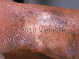 Clinical image of Lymphangiosarcoma - imageId=990911. Click to open in gallery.  caption: 'Grayish and violaceous patches developing in a scarred and lymphedematous limb.'
